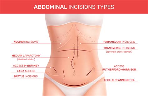 Abdominal Incision Types Infographics 10366621 Vector Art at Vecteezy