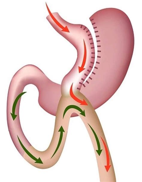 Laparoscopic Mini Gastric Bypass Surgery In New Delhi Coms Clinic