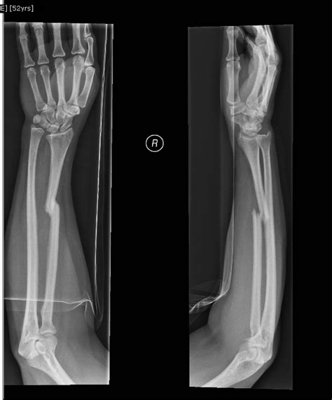 Forearm - Single bone fracture | The Orthopedics Malaysia blog