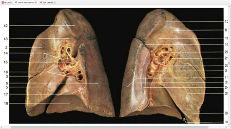 Pulmonary Ligament Cadaver