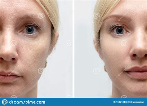 Woman Face With Wrinkles And Age Change Before And After Treatment