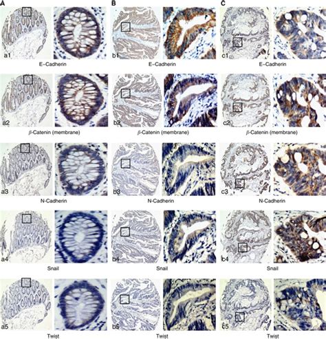 Immunohistochemical Staining Of EMT Related Biomarkers In RC Normal