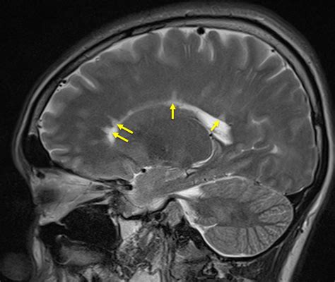 Multiple Sclerosis Mri Dawsons Fingers