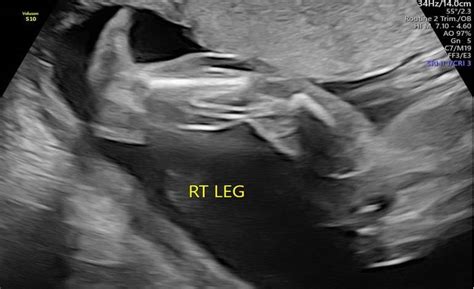 Klippel-Trenaunay syndrome – a classic presentation - ScholarMD