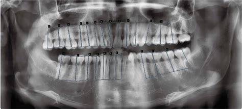 Annotated Panoramic Radiograph For Image Segmentation The Alveolar