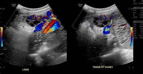 Molar Pregnancy With Coexisting Live Intrauterine Pregnancy Image