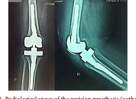 Figure From Refracture Of The Tibial Post After Posterior Stabilized