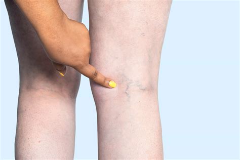 What Is Chronic Venous Insufficiency Metro Vein Centers