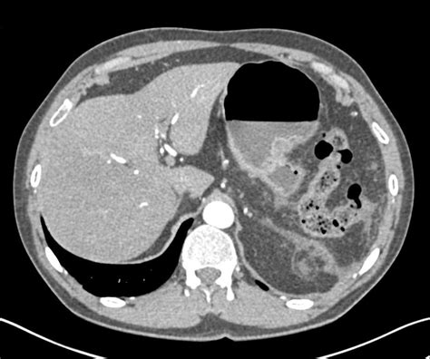 Incidental Neuroendocrine Tumor Pancreas In Patient With Distal