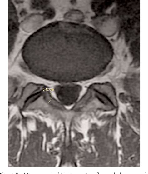 Figure 1 from LIGAMENTUM FLAVUM HYPERTROPHY IN ELDERLY PATIENTS WITH LOW BACK PAIN: A MRI STUDY ...