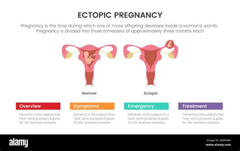 Ectopic Pregnant Or Pregnancy Infographic Concept For Slide