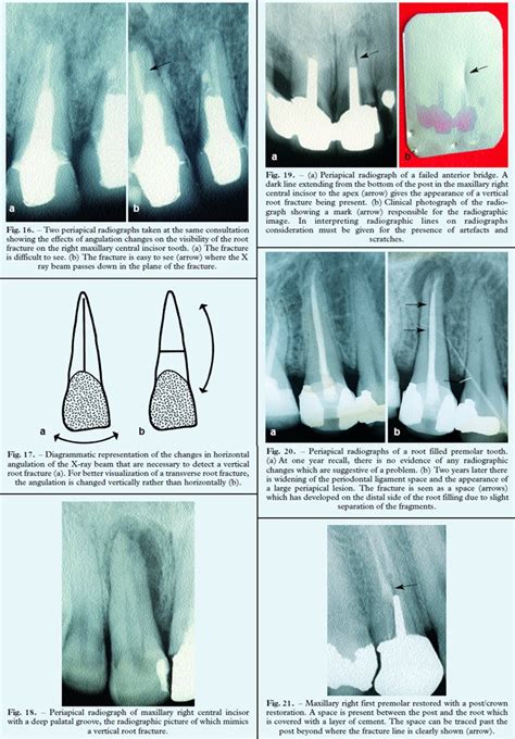 Vertical Root Fractures True Value Dental