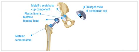 Hip Replacement Surgery Procedures - MIOT Hospitals