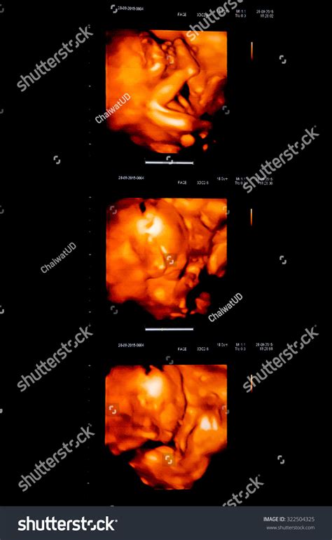 Pictures D Ultrasound Of Baby In Mother S Womb Gestational Age Of