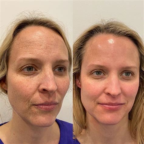 Impresionante Hydrafacial Antes Y Despuesde Todos Los Tiempos