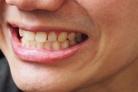 Discoloration And Teeth Stains Living Well Dental Group