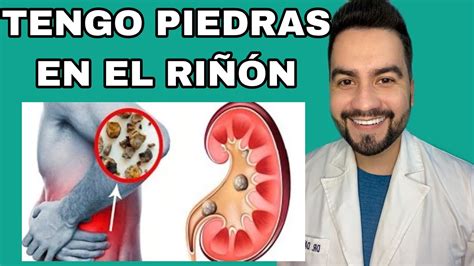 TENGO PIEDRAS EN LOS RIÑONES LITIASIS RENAL COMO ELIMINAR PIEDRAS