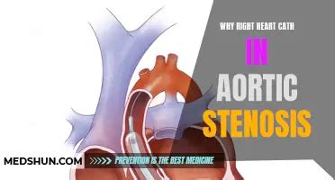 Understanding The Various Levels Of Aortic Stenosis MedShun