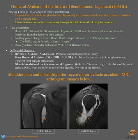 Humeral Avulsion of the Inferior Glenohumeral Ligament ... | Radiology ...