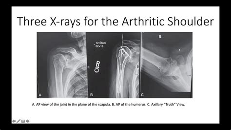 X Raying The Arthritic Shoulder What You Need To Know Youtube