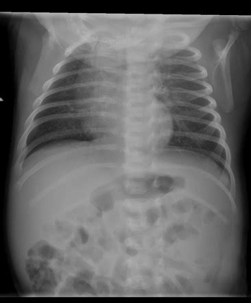 Normal skeletal survey - 1-month-old | Radiology Case | Radiopaedia.org