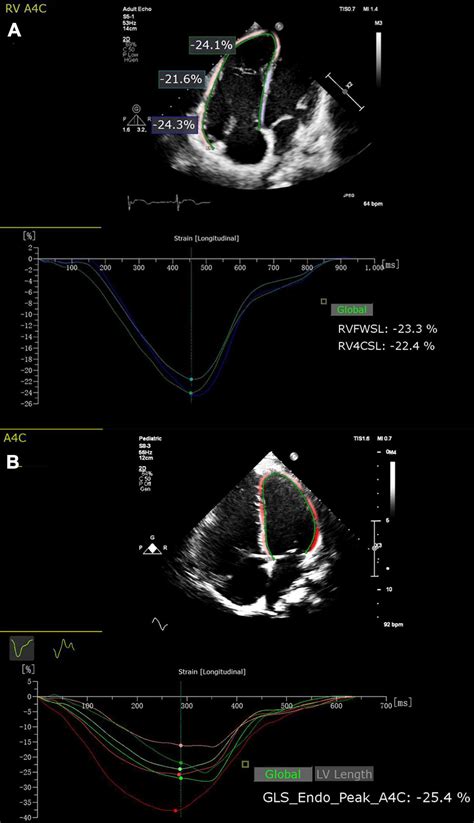 Frontiers Superior Prognostic Value Of Right Ventricular Free Wall