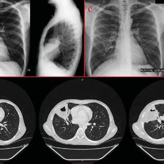 (PDF) Chronic cavitary pneumonia by Rhodococcus equi in a highly prevalent tuberculosis country ...