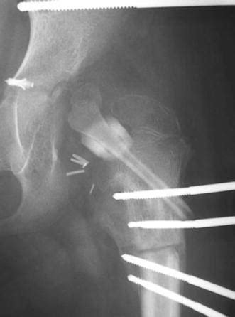 Failed Vascularized Proximal Fibular Epiphyseal Transfer For Hip