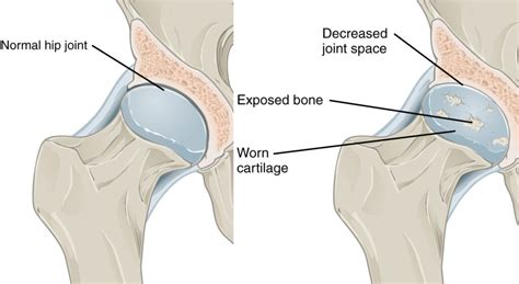 Total Hip Arthroplasty Cu Sports Med Hip Clinic