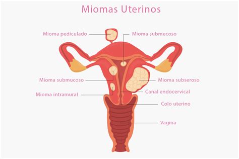 Mioma uterino o que é causas diagnóstico e tratamento Sanar Medicina