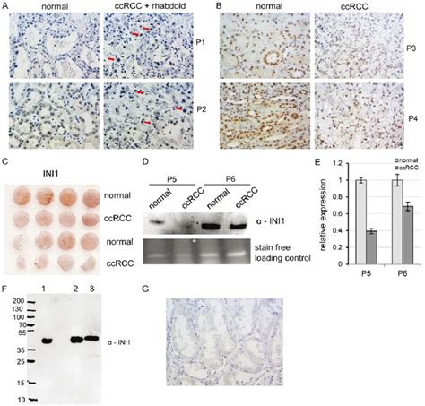 Downregulation Of INI1 In CcRCC Cells But Not In Rhabdoid Cells In