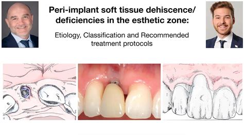 Peri Implant Soft Tissue Dehiscence Deficiencies In The Esthetic Zone