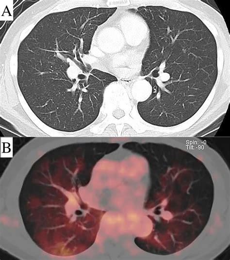 Hot Lung Sign In Intravascular Lymphoma Bmj Case Reports