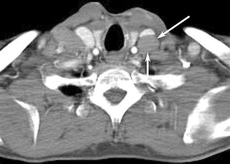 Normal CT Appearance Of The Distal Thoracic Duct AJR