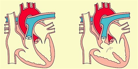 Cardiopatías congénitas Qué son causas síntomas e información