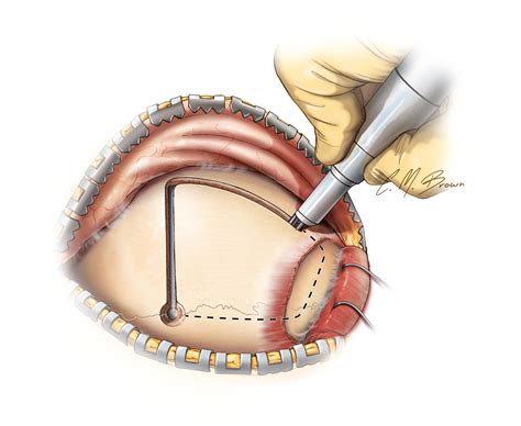 Frontal Lobectomy | The Neurosurgical Atlas