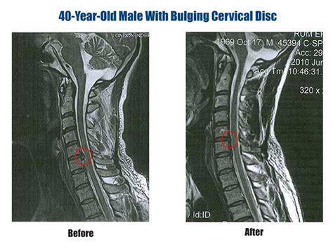 Bulging Disc MRI