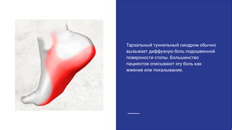 Синдром тарзального канала.. Статьи