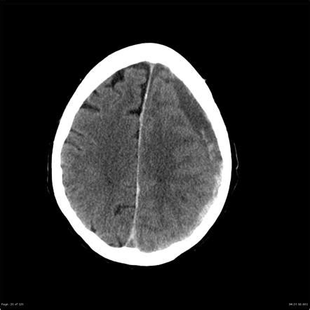 Extradural Haematoma Vs Subdural Haematoma Radiology Reference