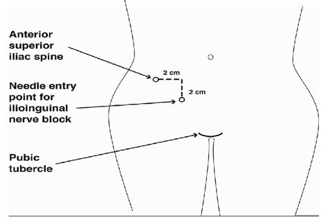 Ilio Inguinal Block On Anatomical Landmarks The Technique Of Iin Block