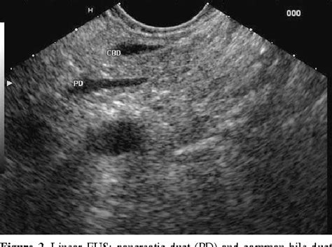 Pancreatic Divisum Ultrasound