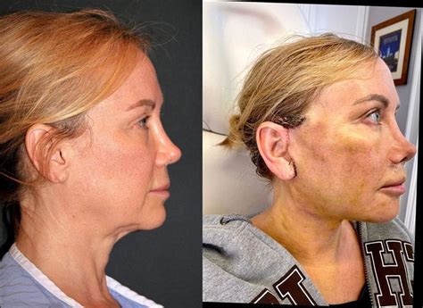 Deep Plane Facelift Before and After - Dr. Andrew Jacono | Face lift ...