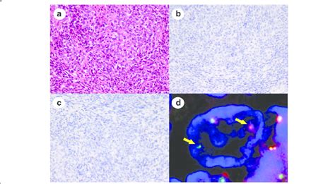 Representative Images Of Poorly Differentiated Synovial Sarcoma Without