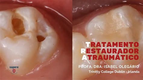 Tratamento Restaurador Atraumático Profa Dra Isabel Olegário