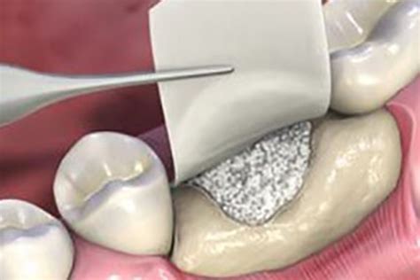 Bone Regeneration Procedures – smilematters