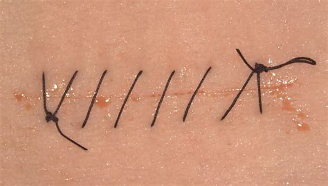 Simple Running Suture Technique How To Master It Upsurgeon