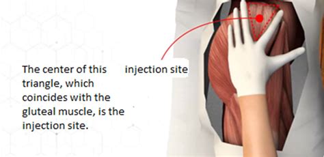 Ventrogluteal region animation screenshot. | Download Scientific Diagram