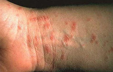 Scabies Rash On Hands