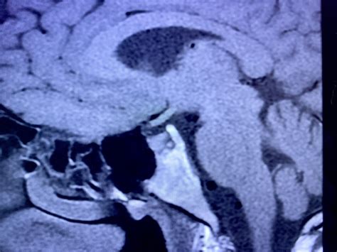 [Joining the Club] - 29[M] Diagnosed with a Pituitary Macroadenoma