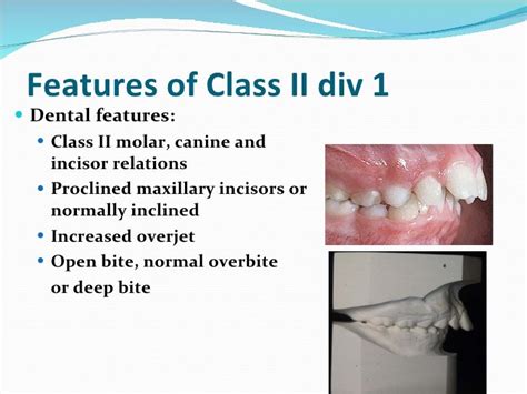 Management Of Class Ii Division 1 Malocclusion